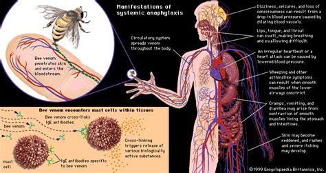 anaphylaxis | physiology | Britannica