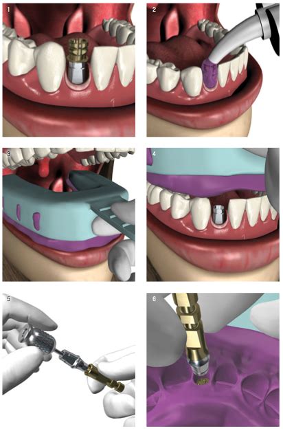 ZEST Anchors introduces CHAIRSIDE® Implant Practice US