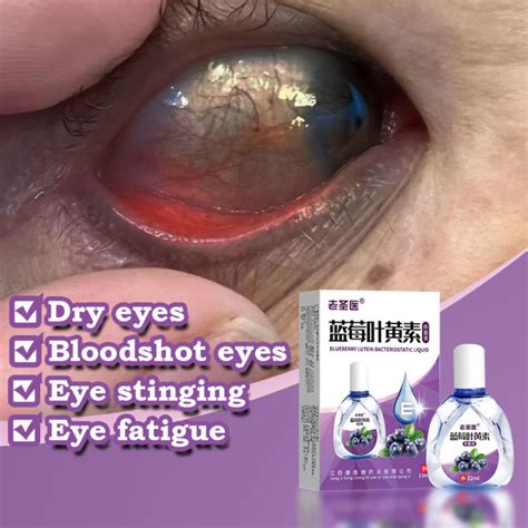 Eye drops Blueberry Lutein Eyesight Lutein Itchy Eyes Pain Reliever Nourishing dicine ...