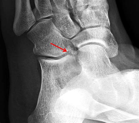 Anterior Calcaneus Fracture