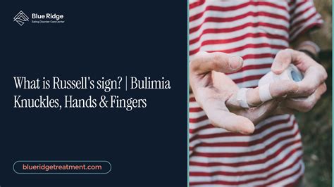 What is Russell's sign? | Bulimia Knuckles, Hands & Fingers