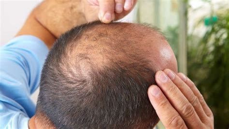 30 Haircuts for Balding Crown - Hide Bald Spots within Minutes