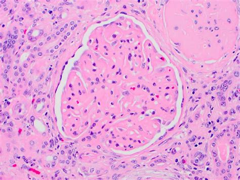 Membranous Nephropathy Histology