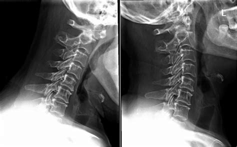 Preoperative x-ray revealing atlantoaxial instability. | Download ...