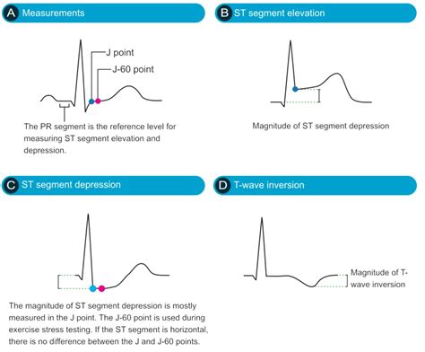 Classification of Acute Coronary Syndromes (ACS) & Acute Myocardial ...