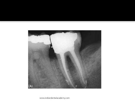 Endo perio lesion/prosthodontic courses