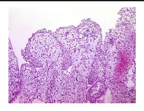 Globulomaxillary cysts—do they really exist? | Semantic Scholar