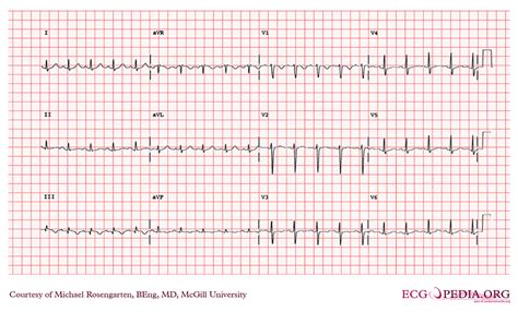 Complications after heart cath | General center | SteadyHealth.com