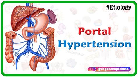 Portal hypertension USMLE Step 1 : Etiology, Clinical features ...