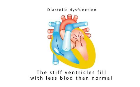 Symptoms Of Diastolic Heart Failure