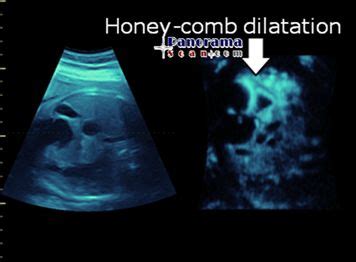 Sonogram - Hirschsprung's disease in Ultrasound - Sonogram T_1055 | Sonography, Abdominal ...