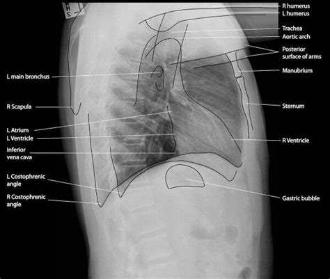 Left lateral chest projection | Radiology, Radiology student, Medical ...