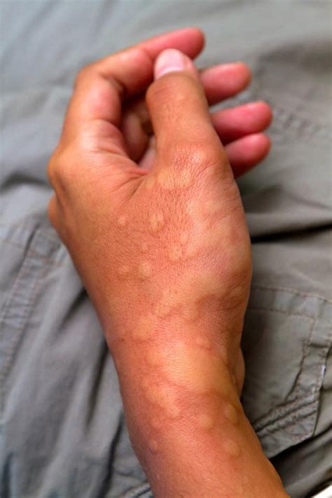 Netizen warns of the dangers from cold urticaria