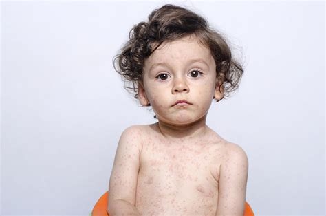 Chicken Pox Rubella Rash Vs Measles Rash - Goimages Dome