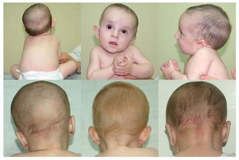 retrocollis and torticollis - Buscar con Google Sternocleidomastoid Muscle, Physical Therapist ...