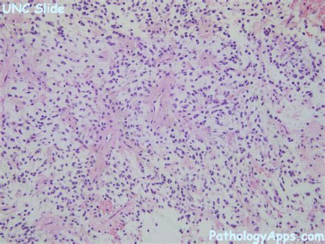 pilomyxoid astrocytoma pathology