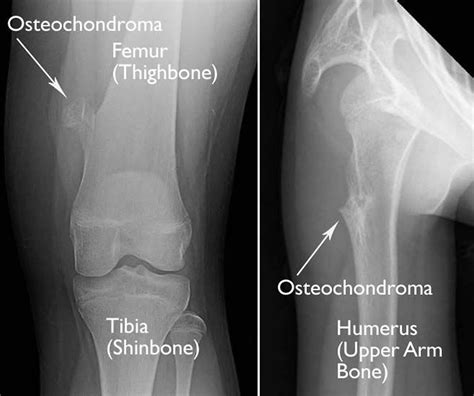 Osteochondroma causes, symptoms, diagnosis & osteochondroma treatment