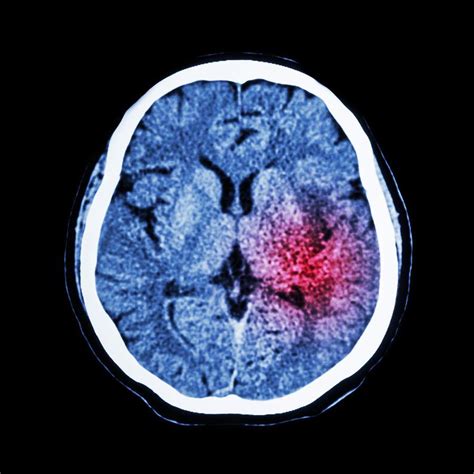 What Causes Non-Penetrating Traumatic Brain Injuries? | Blog