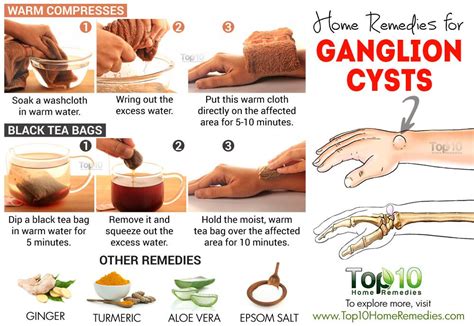 Home Remedies for Ganglion Cysts | Top 10 Home Remedies