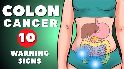 Colon Cancer Symptoms | Colorectal Cancer | 10 warning signs of Colon Cancer | Colon Cancer