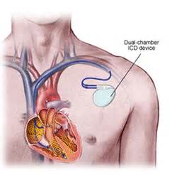 Implantable Cardioverter Defibrillator (ICD) | Willard Walker Heart Institute