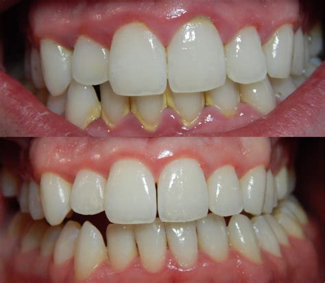 How Much Do You Know About Dental Scaling? - GlobalDentalPro