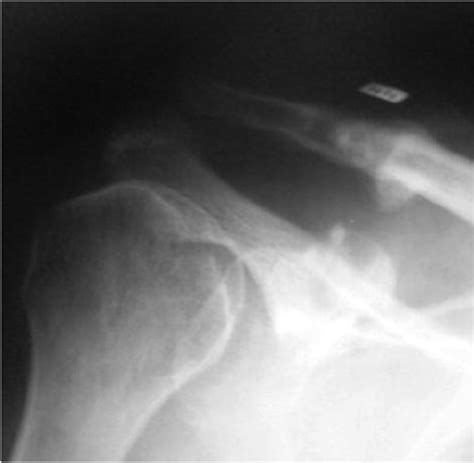 Postoperative radiograph demonstrating fracture of the coracoid... | Download Scientific Diagram