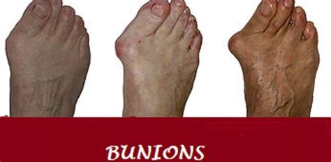 Brooks Shoes for Bunions (May-2023) - Best Shoes Reviews