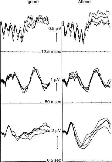 Brainstem Auditory Evoked Potentials: Methodology, Interpretation, and Clinical Application ...