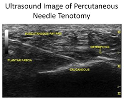 Percutaneous Needle Tenotomy - Motion Is Medicine