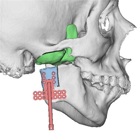 Treatment for Tmj ankylosis - MEDizzy