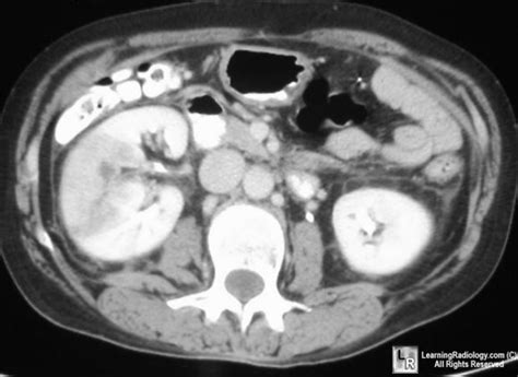 LearningRadiology - Acute Pyelonephritis