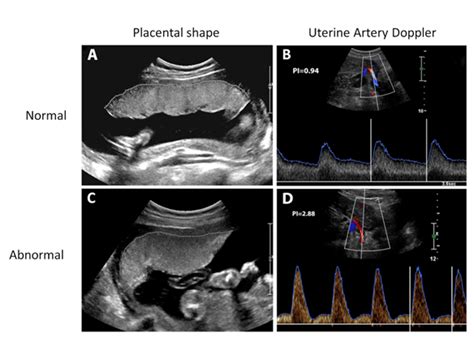 Placental Health Study - Ontario Fetal Centre