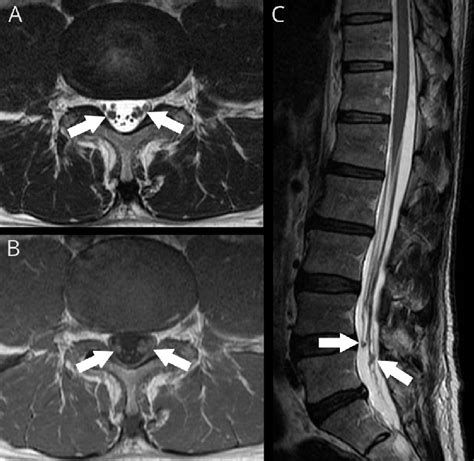 Cauda Equina Mri