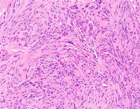 Epithelioid Mesothelioma Pathology Outlines - Goimages 411