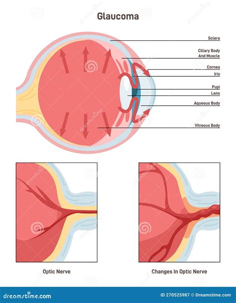 Glaucoma. Damage To the Optic Nerve and Can Lead To Vision Loss Stock Vector - Illustration of ...