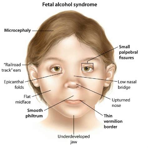 Does Elphie Have Signs of Fetal Alcohol Syndrome(FASD)? : r/Elphaoriondoherty