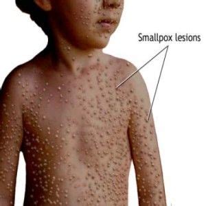 Symptoms Of Smallpox | Medical knowledge, Health care, Nursing crib