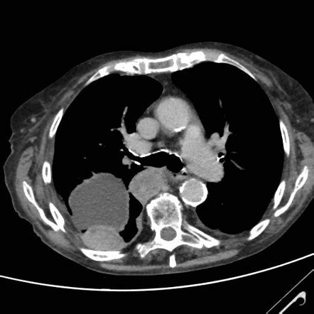 Mesothelioma | Radiology Reference Article | Radiopaedia.org