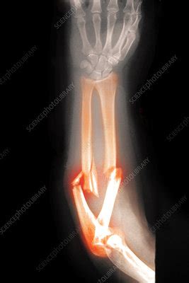 Angulated and Comminuted Fracture - Stock Image - C027/2659 - Science ...