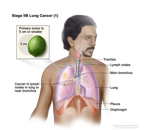 Non-Small Cell Lung Cancer | Vanderbilt-Ingram Cancer Center