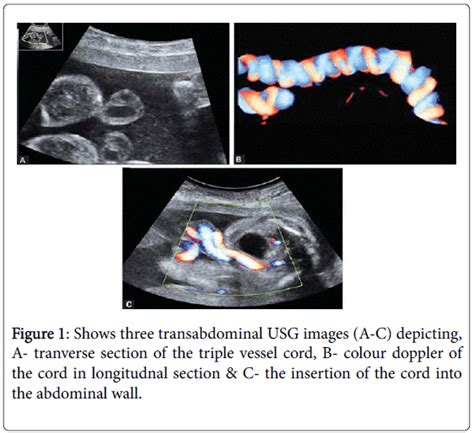 "Coils & Kinks": A Novel Technique to Evaluate the Perinatal Outc