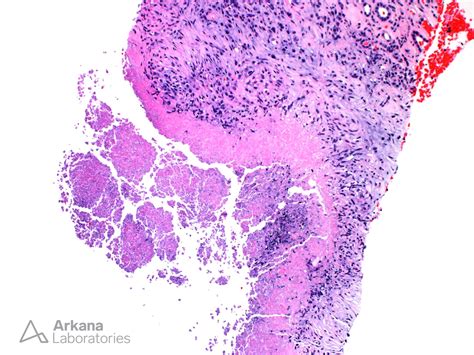 Caseating Granuloma | Teaching Points | Arkana Laboratories