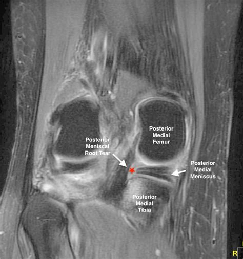 Root Tears Of The Meniscus (Video) - Town Center Orthopaedics