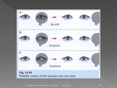 Ocular motility and strabismus