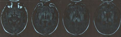Hypoxic Brain Injury-MRI - Sumer's Radiology Blog