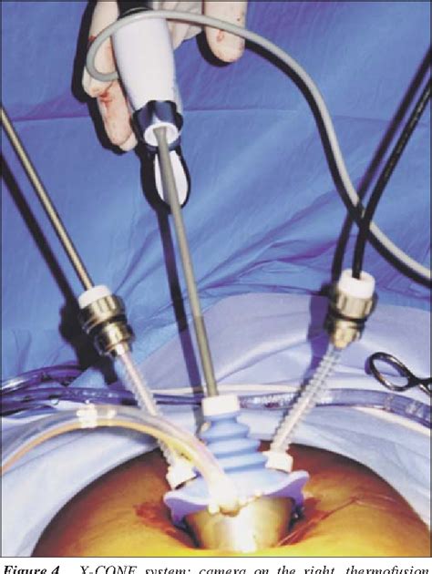 Subtotal Hysterectomy with Single Port Access Laparoscopy: Gadget or Progress? | Semantic Scholar