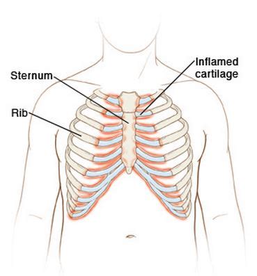 Bruised Sternum Symptoms, Pain, Treatment and How to Heal a Bruised Sternum