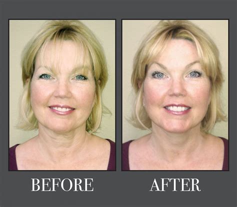 Instant Face Lift - Bring It Up | Face lift tape, Instant face lift, Facelift