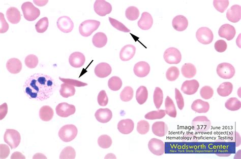 sickle cell anemia under microscope - quinton-oyler